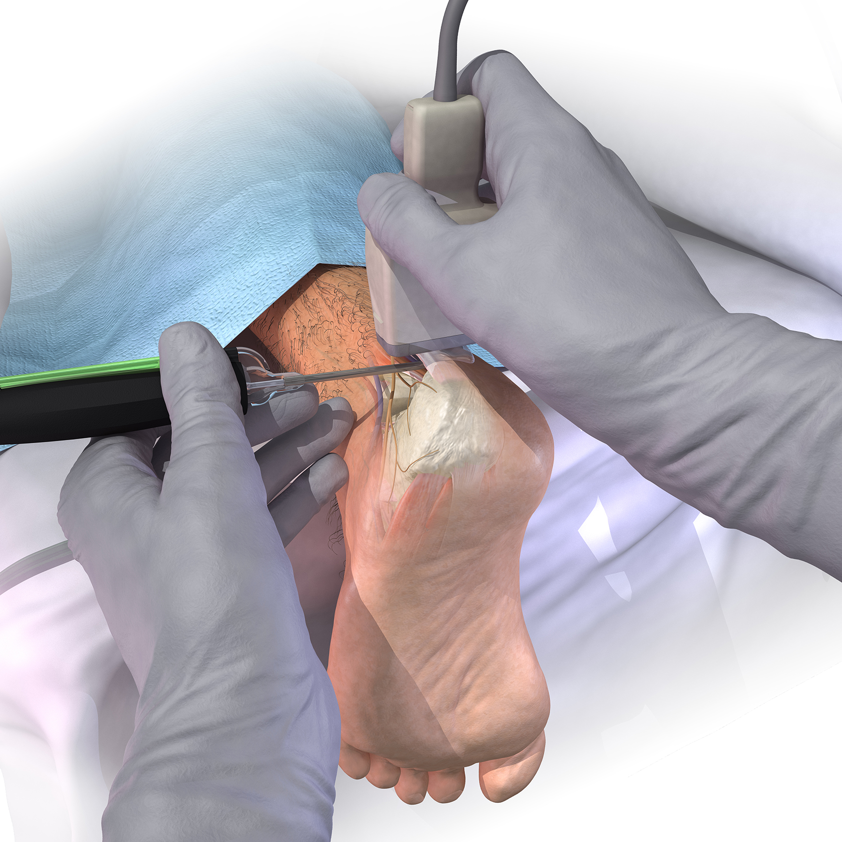 Medical Illustration Haglund's Deformity Repair A KYU Design